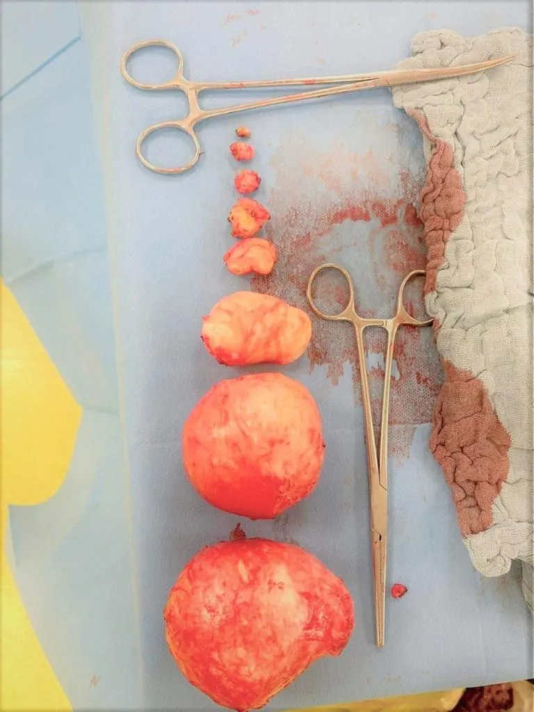 Pacientă cu opt fibroame, operată cu succes la Constanța – foto 2